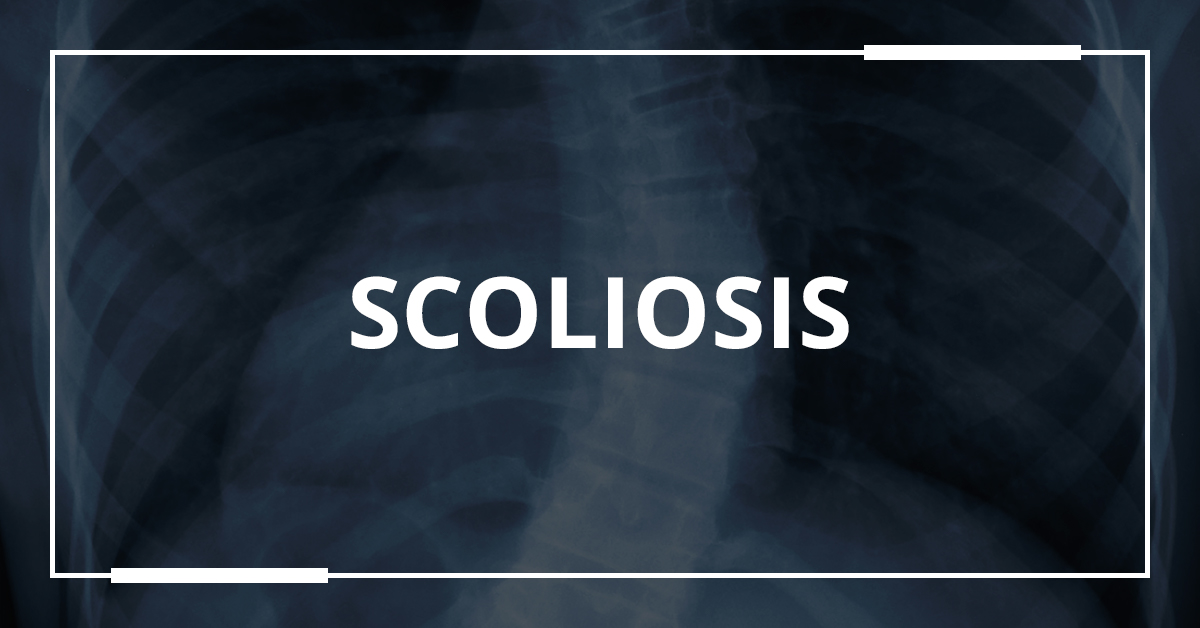 Spine 20year Coligge Girls Xxx Video - Scoliosis - Everything To Know | OrthoBethesda