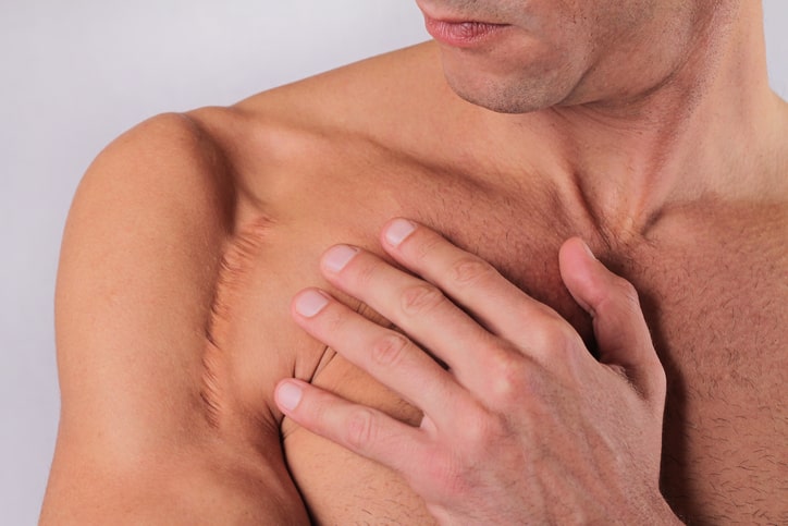 Rotator Cuff Disorders: The Facts - OrthoBethesda